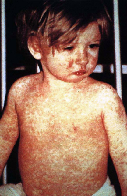 A child with a 4-day measles rash 